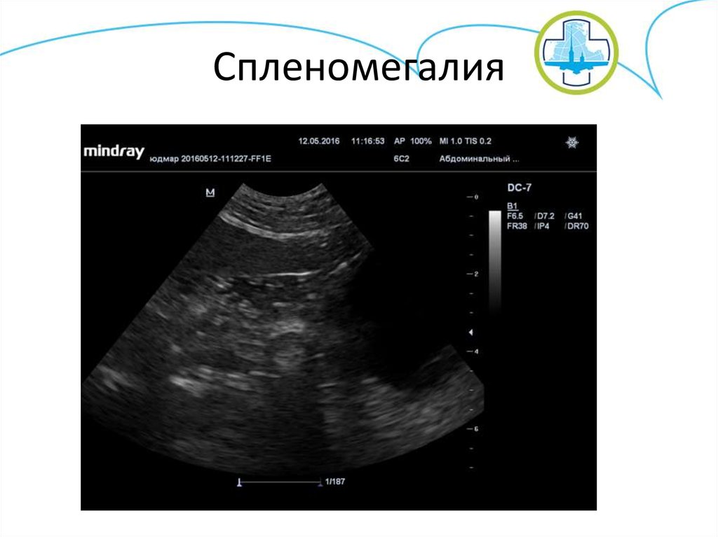 Спленомегалия. Спленомегалия осложнения. Спленомегалия не характерна для. Минимальная спленомегалия.