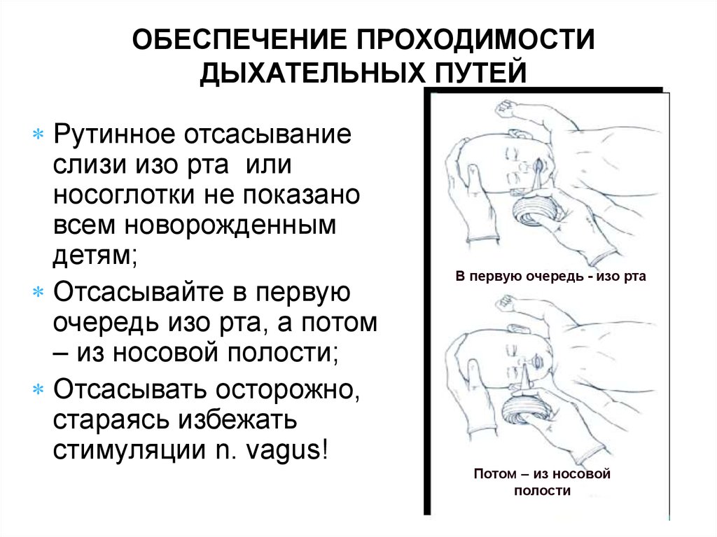 Как обеспечить проходимость дыхательных путей. Отсасывание слизи из верхних дыхательных путей. Технику отсасывания слизи из дыхательных путей новорожденных. Техника аспирации слизи из верхних дыхательных путей. Отсасывание слизи у новорожденного из верхних дыхательных путей.