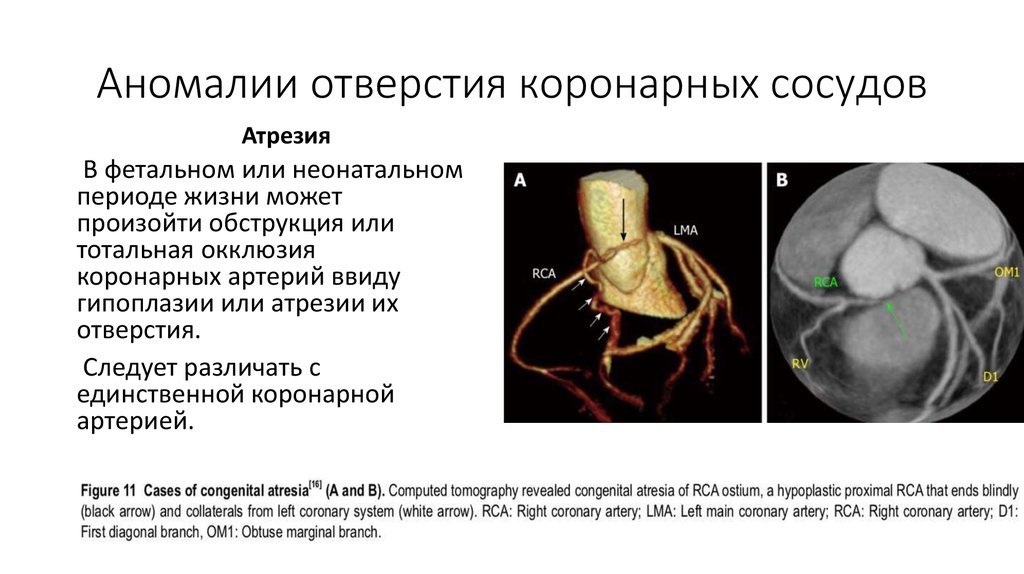 Гипоплазия правого синуса. Врожденные аномалии отхождения коронарных артерий. Порок коронарных артерий. Аномалия коронарных артерий у детей. Аномальное отхождение коронарных артерий.