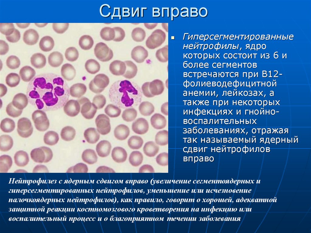 Сегментоядерные нейтрофилы в крови что это значит