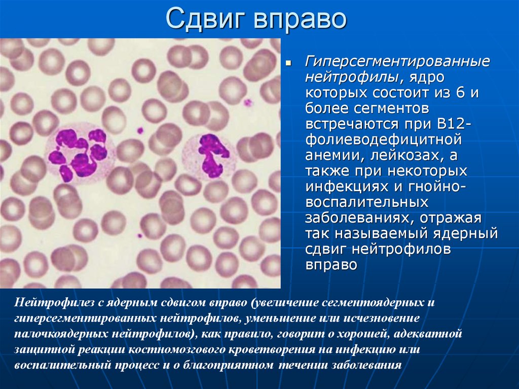 Лейкоцитоз нейтрофилез