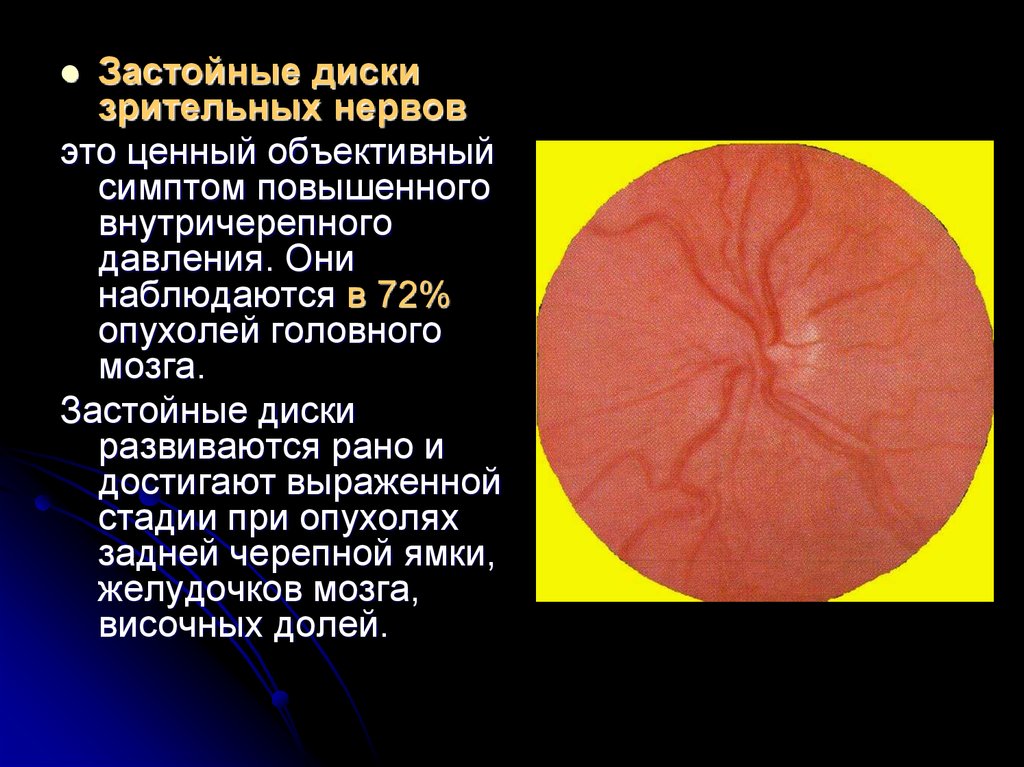 Диск глазного нерва. Застойный диск зрительного нерва. Опухоли диска зрительного нерва. Отечный диск зрительного нерва.