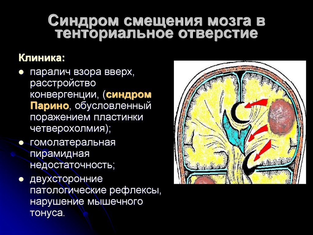 Виды опухолей головного. Синдромы опухолей головного мозга. Синдром смещения мозга тенториальное отверстие. Тенториальное отверстие тенториальное отверстие. Вклинение головного мозга.