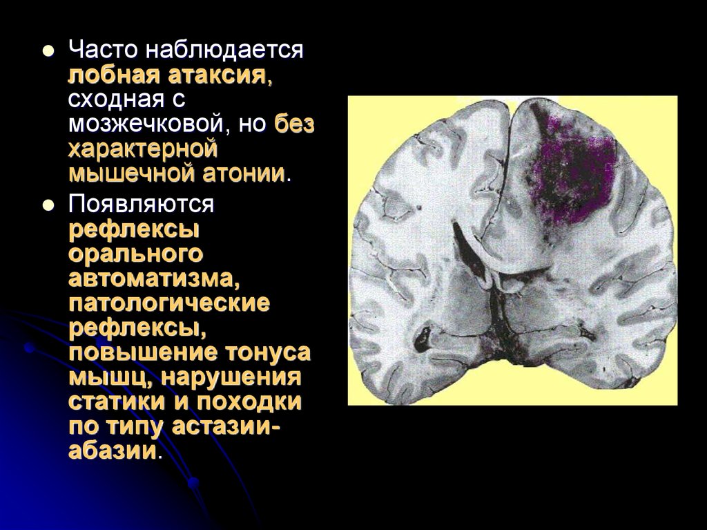 Опухоль головного мозга презентация