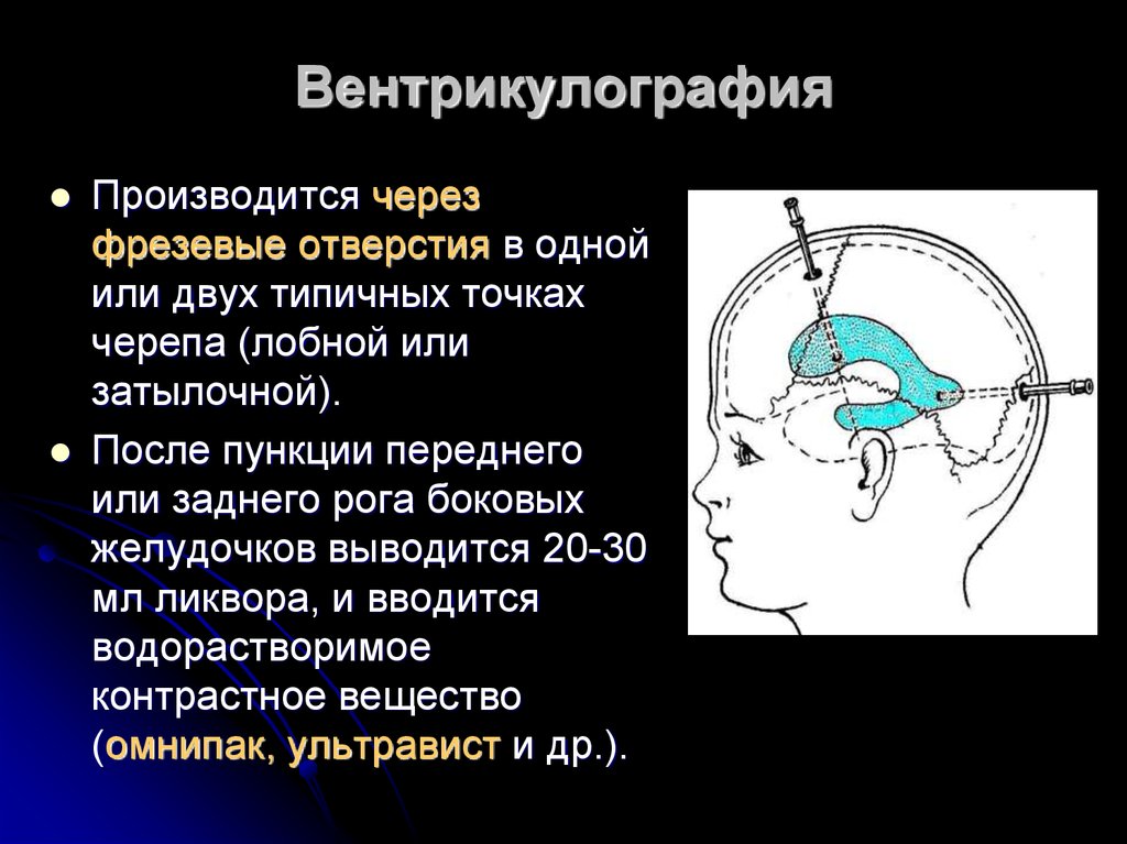 Как делают пункцию мозга