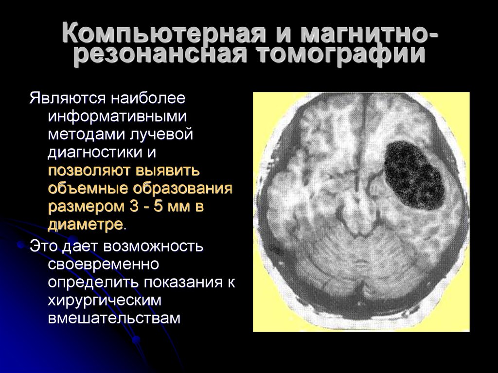 Диагноз опухоли мозга. Лучевая диагностика опухолей головного мозга. Опухоли головного мозга презентация. Методы лучевой диагностики головного мозга. Диагноз опухоль головного мозга.