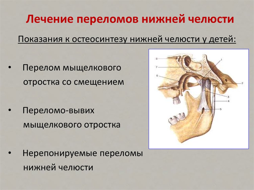 Мыщелки челюсти. Перелом мыщелкового отростка нижней челюсти. Остеосинтез суставного отростка нижней челюсти. Перелом мыщелкового отростка нижней челюсти кт. Перелом Нижнего суставного отростка.