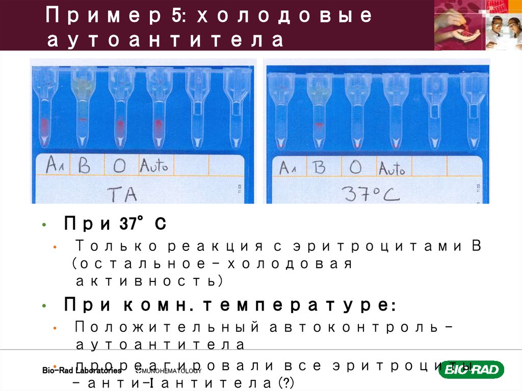 Пример 5: холодовые аутоантитела