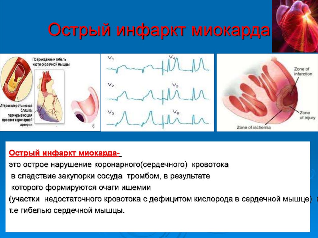 Оим в медицине. Острый 121.9 инфаркт миокарда неуточненный. Острый инфаркт миокарда (ОИМ). Острая стадия инфаркта миокарда локализация. Клиника острого периода инфаркта миокарда.