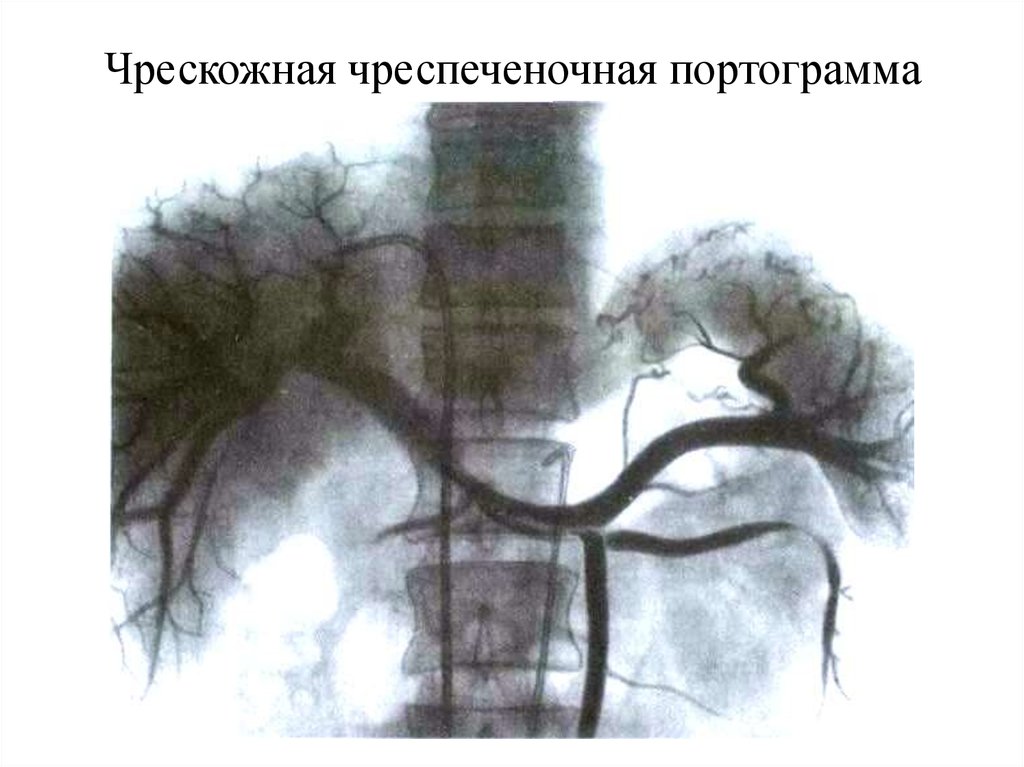 Холедохолитиаз факультетская хирургия презентация