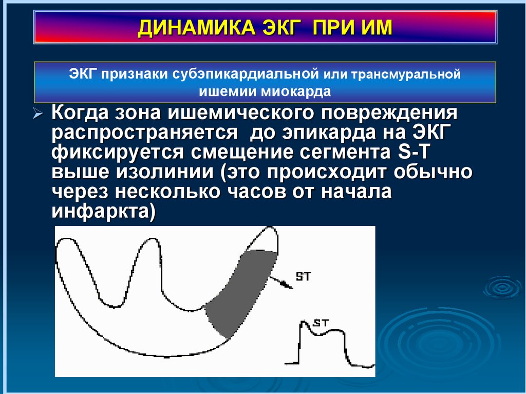 Экг в динамике что это. Субэпикардиальная повреждение на ЭКГ. Динамика ЭКГ. Субэпикардиальная ишемия. Субэпикардиальная ишемия на ЭКГ.