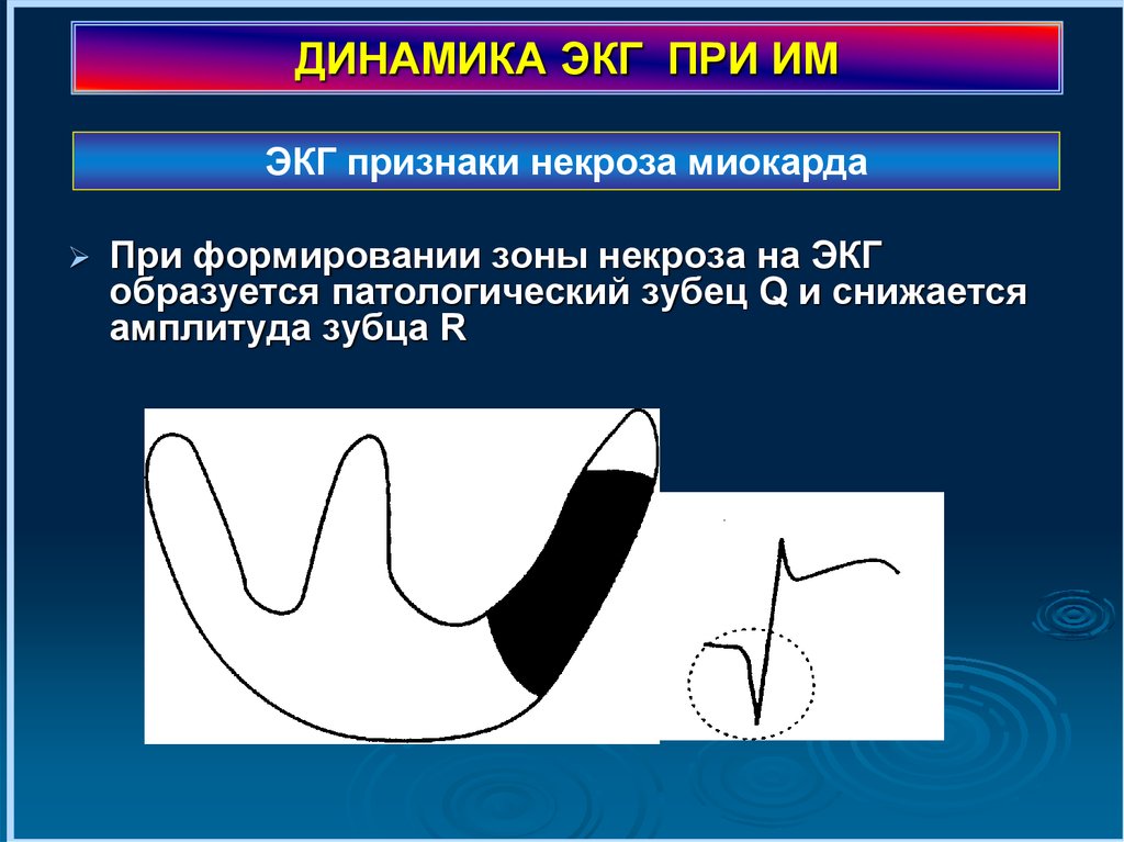 Экг признак некроза. Динамика ЭКГ. Зона некроза на ЭКГ. Зона некроза проявляется на ЭКГ. Некроз миокарда на ЭКГ.