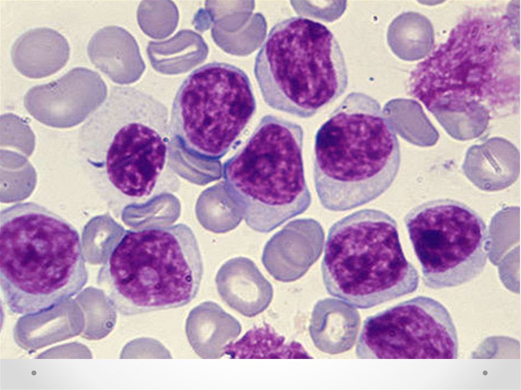 Картина крови при миелобластном лейкозе
