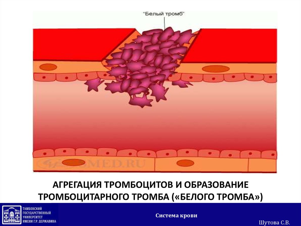 Основной тромб. Тромбоциты крови тромб образование. Образование тромбоцитарного тромба. Образование белого тромба. Агрегация тромбоцитарного тромба.