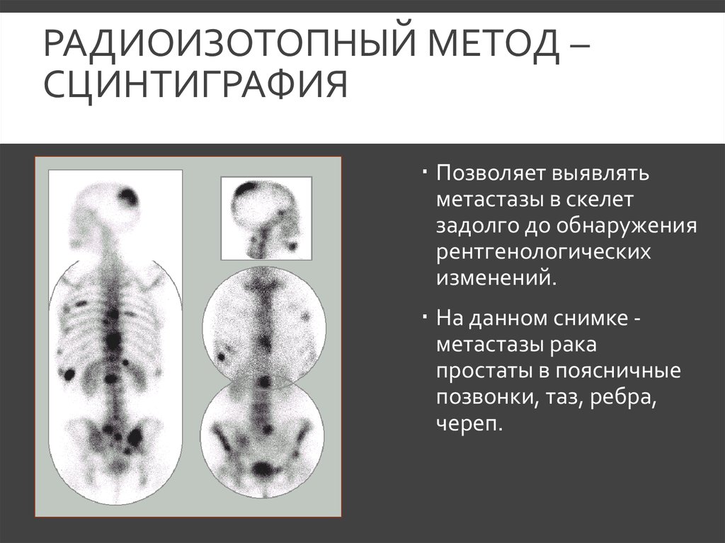 Остеосцинтиграфия при раке молочной железы