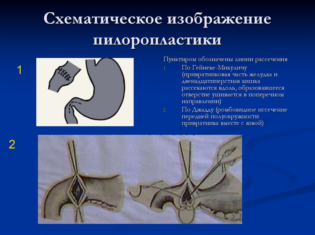 Пилоропластика по финнею схема