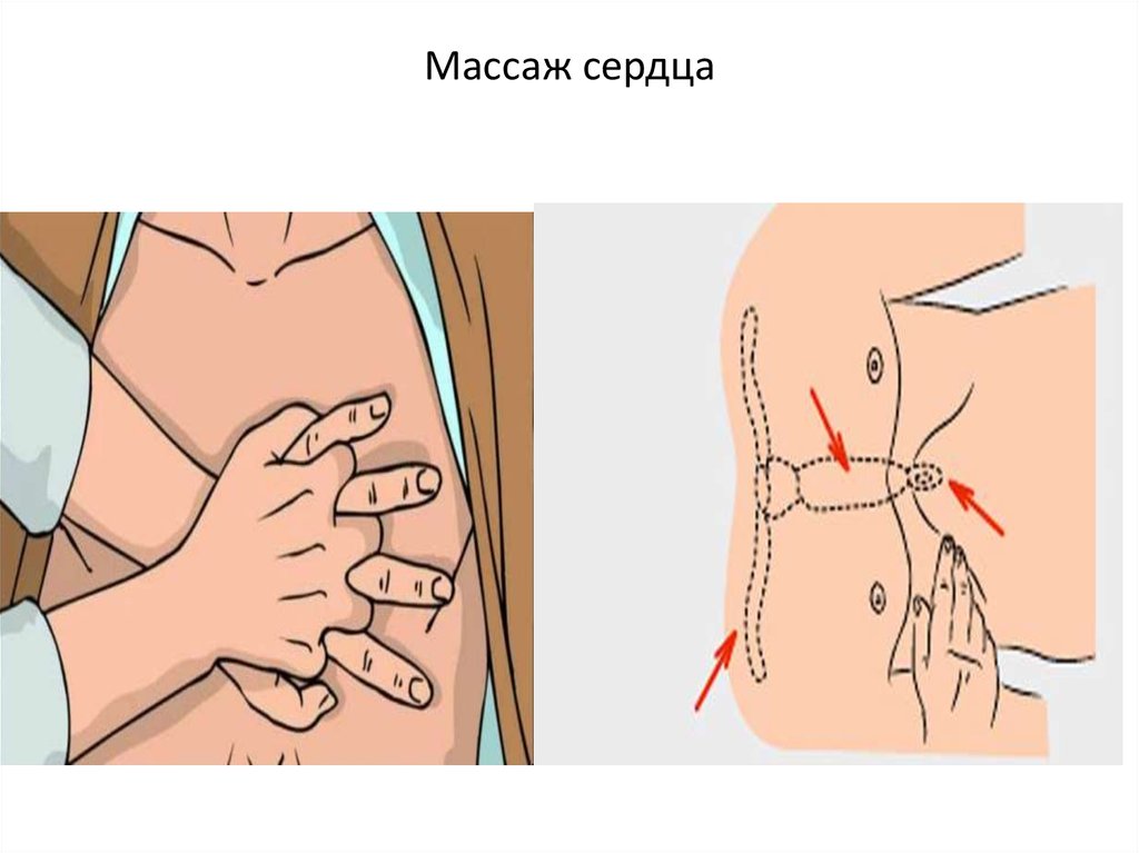 Прямой массаж сердца картинки