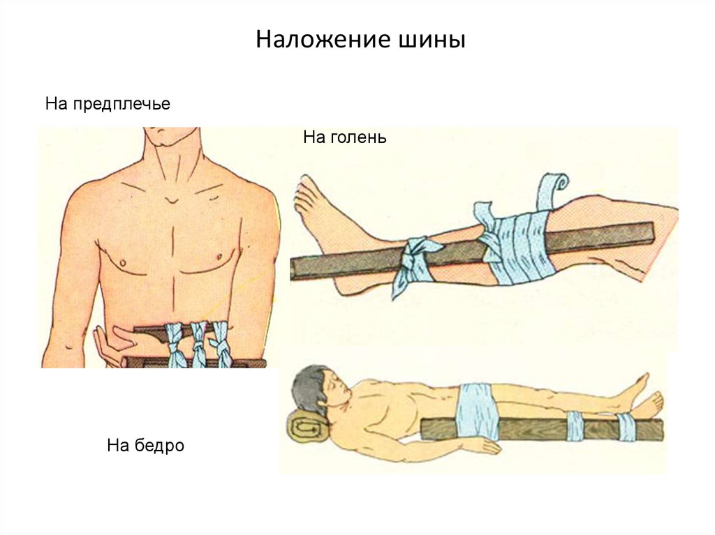 Шины накладывают при переломах. Порядок наложения шины при переломе. При переломе костей предплечья шина накладывается. При переломах конечностей накладывается шина. При переломах костей конечностей накладывается шина:.