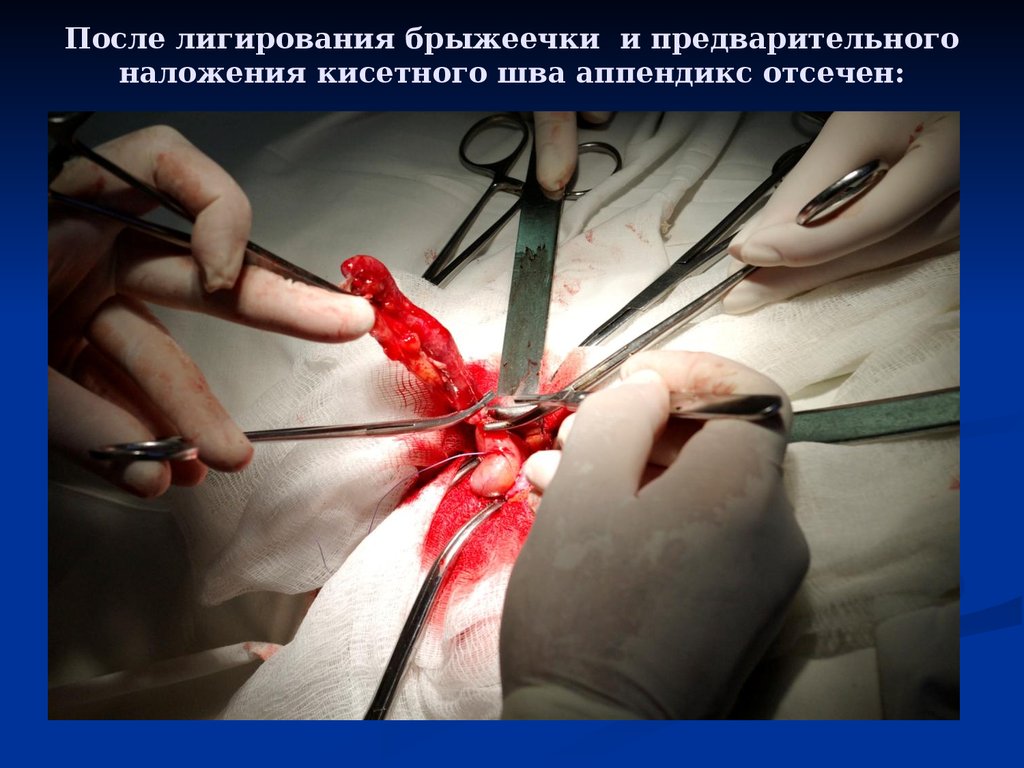 После лигирования брыжеечки и предварительного наложения кисетного шва аппендикс отсечен: