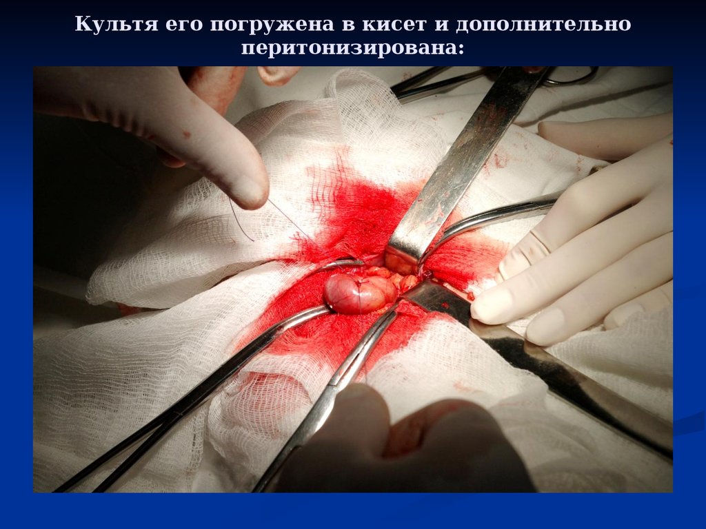 Культя его погружена в кисет и дополнительно перитонизирована: