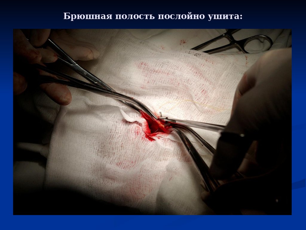 Брюшная полость послойно ушита: