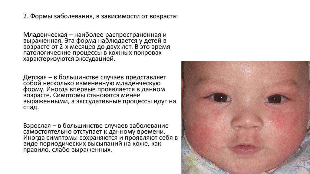 Атопический дерматит симптомы и лечение у взрослых Атопический дерматит симптомы и лечение у взрослых