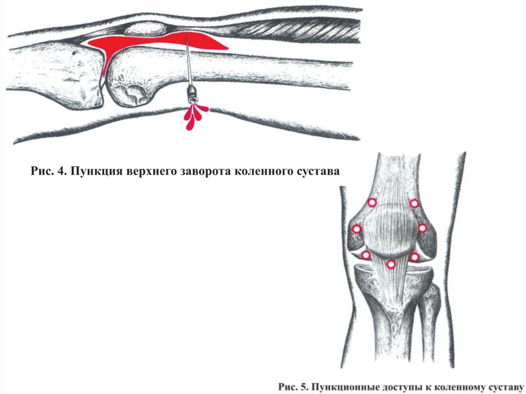 Пункция коленного сустава. Пункция верхнего заворота коленного сустава. Боковой заворот коленного сустава анатомия. Пункция коленного сустава схема. Верхний заворот коленного сустава анатомия.