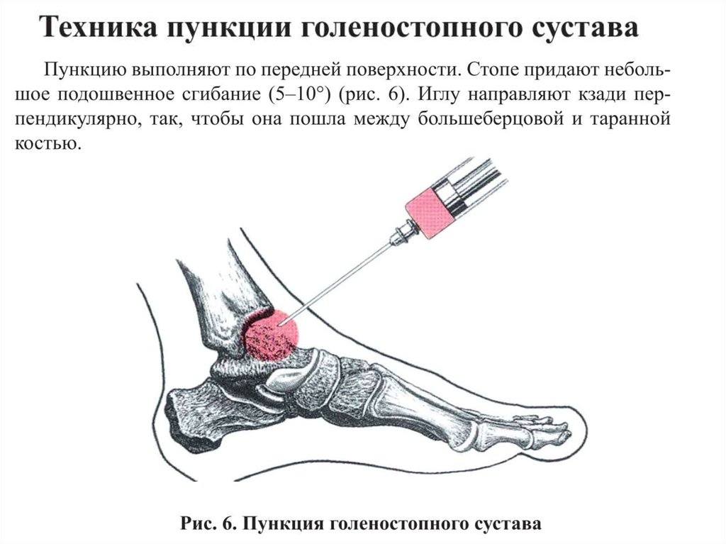 Укол дипроспана в коленный сустав