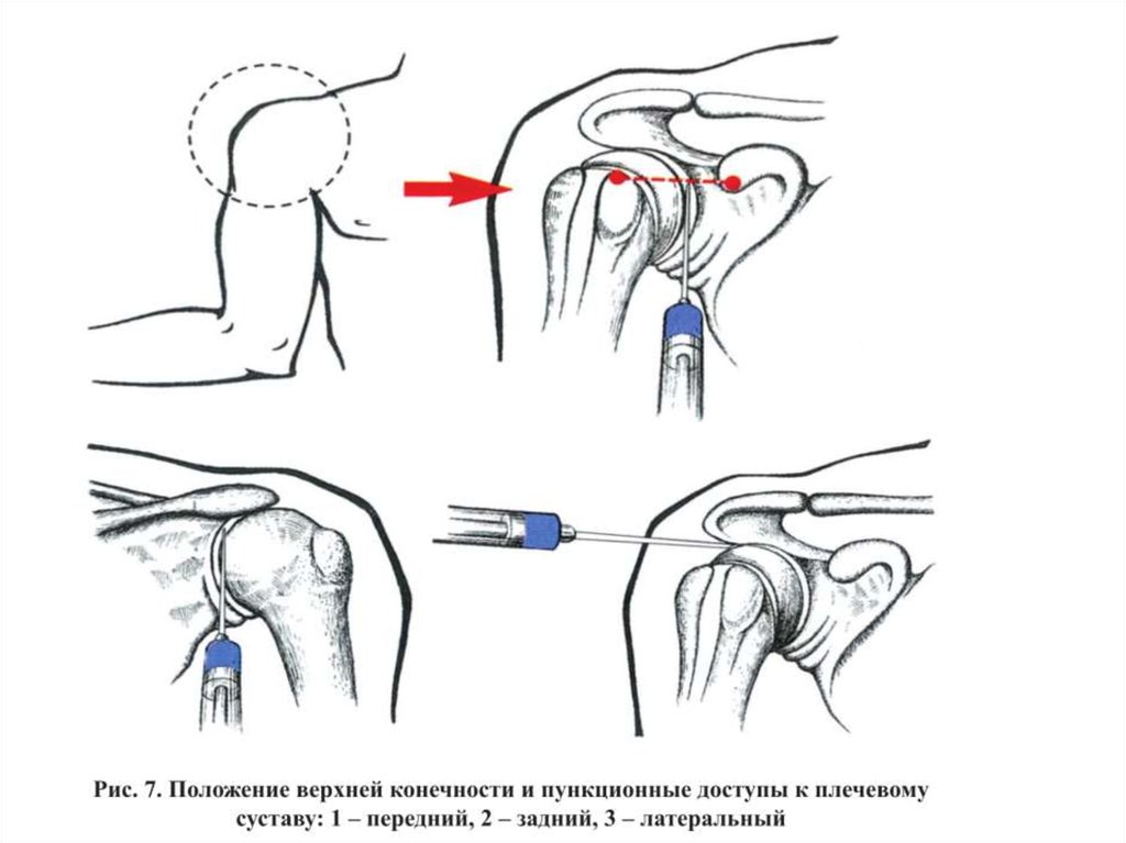Блокада плечевого сустава. Пункция плечевого сустава схема. Точки пункции плечевого сустава. Внутрисуставные инъекции в плечевой сустав техника. Внутрисуставная пункция плечевого сустава.