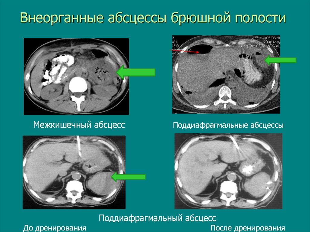 Внеорганные абсцессы брюшной полости