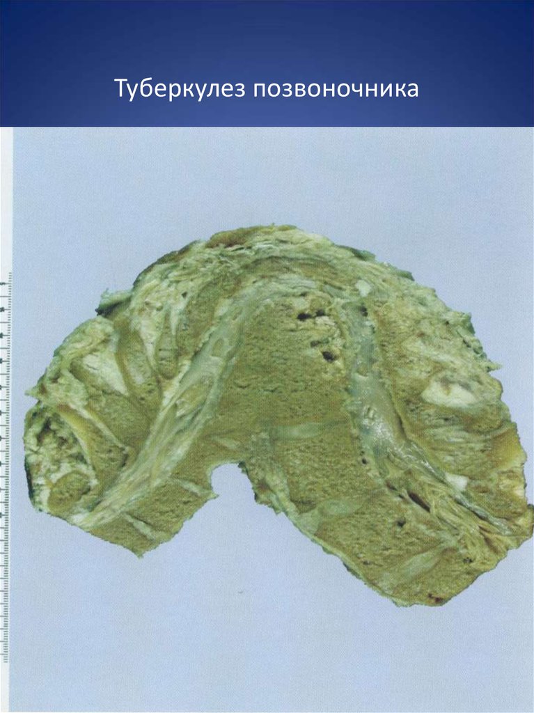 Туберкулез позвоночника