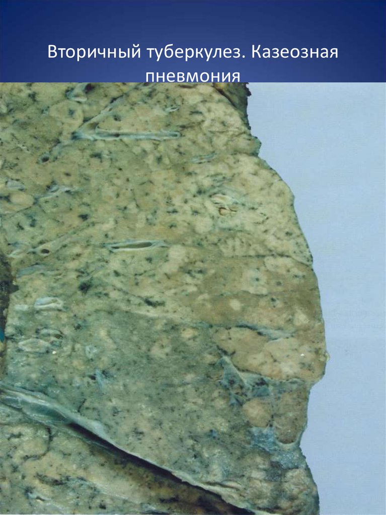 Вторичный туберкулез. Казеозная пневмония
