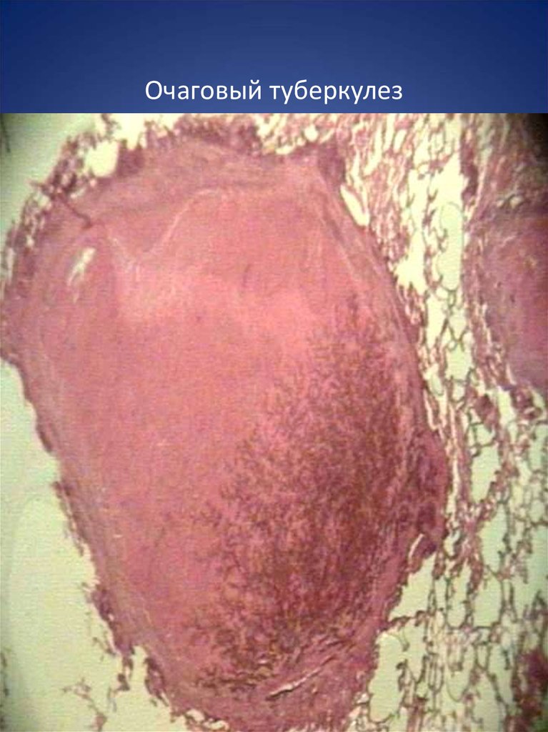 Очаговый туберкулез