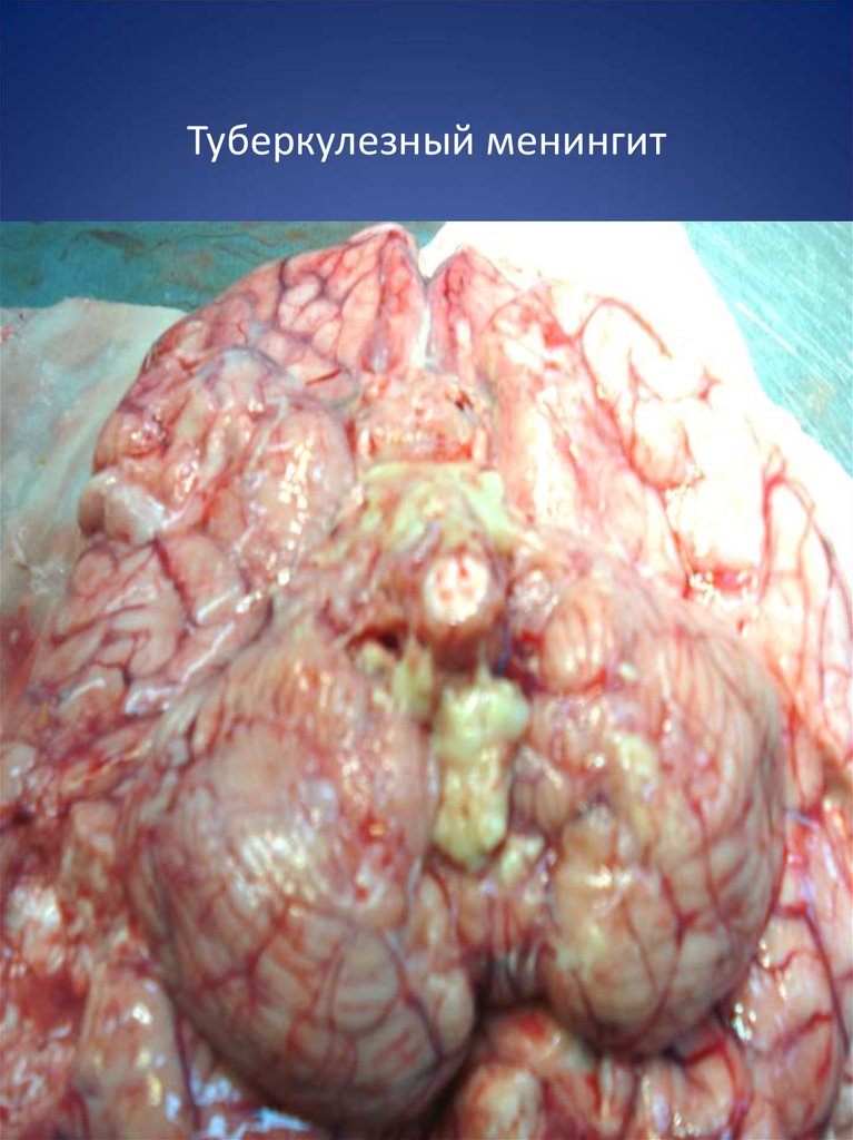 Туберкулезный менингит