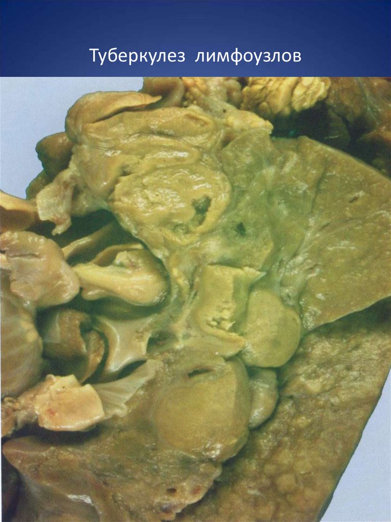 Туберкулез лимфоузлов