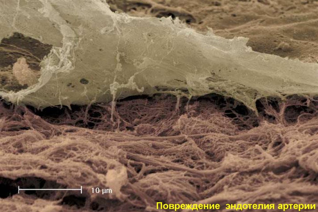 Повреждение мельчайших кровеносных сосудов. Повреждение эндотелия. Эндотелий сосудов. Поврежденный эндотелий сосудов. Дисфункция эндотелия сосудов.