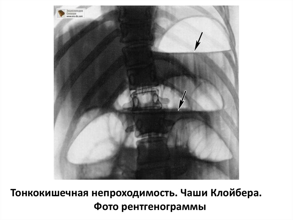 Обзорная рентгенография брюшной полости. Чаши Клойбера на рентгенограмме при кишечной непроходимости. Тонкокишечная непроходимость рентген. Заворот кишок рентгенограмма обзорная.