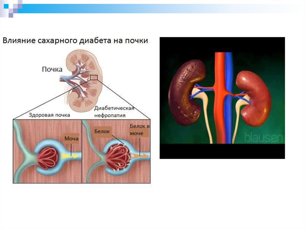 Почечный диабет. Осложнения сахарного диабета биохимия. Осложнения сахарного диабета презентация. Органы мишени при сахарном диабете.