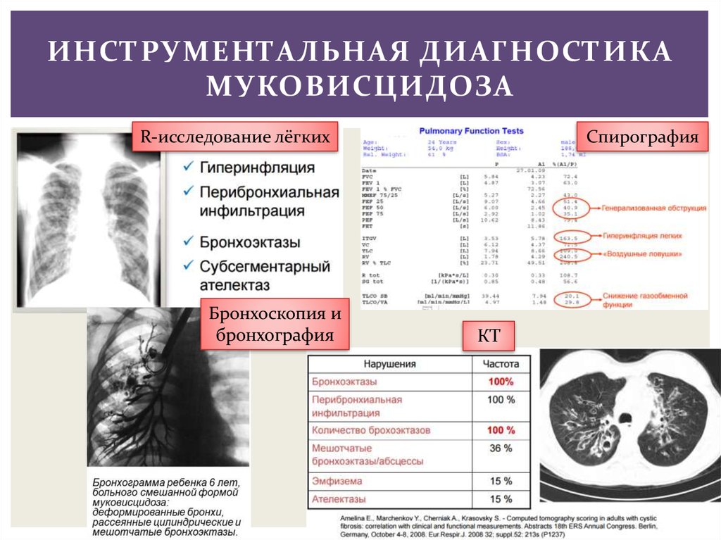 Кистозный фиброз фото