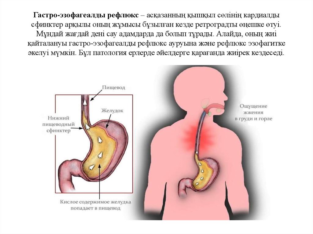 Нижний рефлюкс. Сфинктер между желудком и пищеводом. Сфинктер желудка и пищевода.