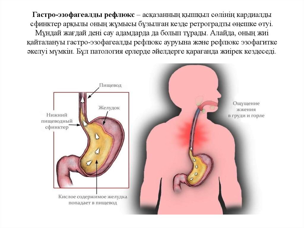 Как избавиться от рефлюкса. Сфинктер между желудком и пищеводом. Сфинктер желудка и пищевода.