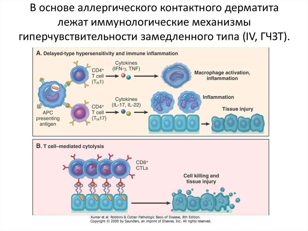 Гиперчувствительность 1 типа схема