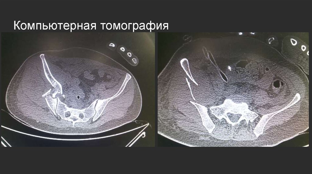 Компьютерная томография
