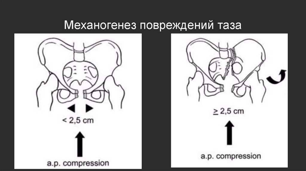 Переломы костей таза - презентация онлайн