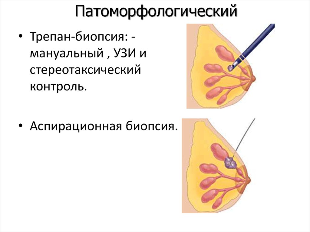 Через сколько биопсию молочной железы