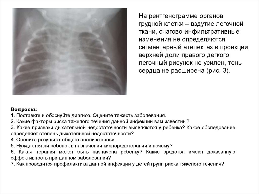 Без очаговых и инфильтративных изменений. Рентгенография грудной клетки при дыхательной недостаточности. Рентген грудной клетки ателектаз. Рентгенография грудной клетки у детей норма описание.