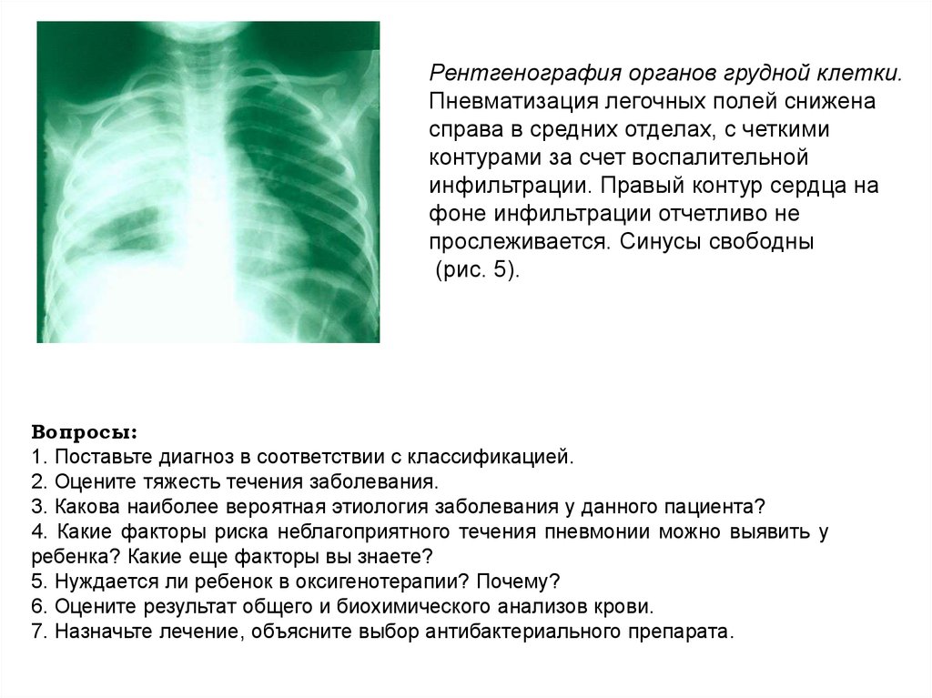 В нижних отделах легочный рисунок. Пневматизация легочных полей. Что такое снижение пневматизации легочной. Пневматизация легочной ткани. Диффузное снижение пневматизации легочной ткани.