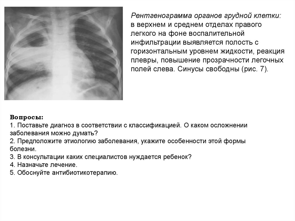 Заболевания грудной клетки. Полость с горизонтальным уровнем жидкости в легких. Показатели рентгенографии грудной клетки. Горизонтальный уровень жидкости в легких. Уровень жидкости на рентгенограмме легких.