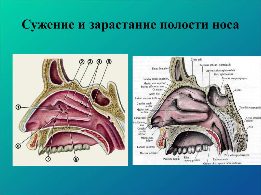 Полость нормально. Носовая полость строение хоаны. Полость носа строение. Сужение и зарастание полости носа. Строение носовых ходов.