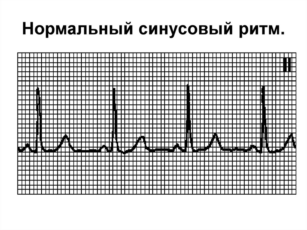 Нормальный ритм. .Клиническая и ЭКГ-диагностика аритмий.. Ритм.